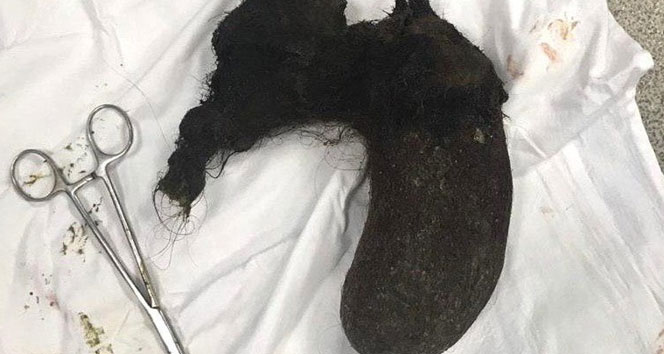 10 yıl boyunca yediği saçları ameliyatla midesinden çıkarıldı