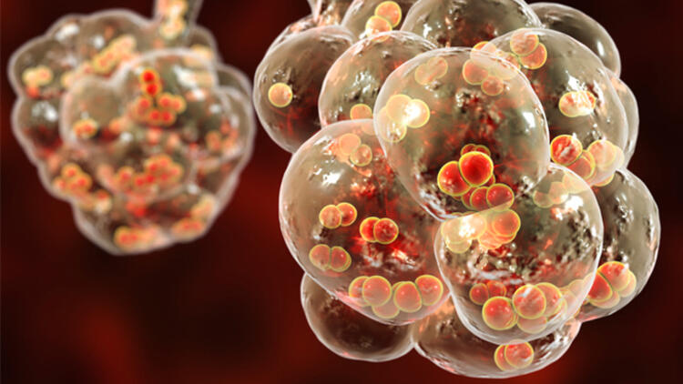 Bu hastalık en çok Türkiye’de görülüyor: Alveoler mikrolitiazis